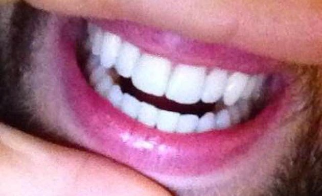 Photo of €99 Laser Teeth Whitening Cork - White Smile Clinic