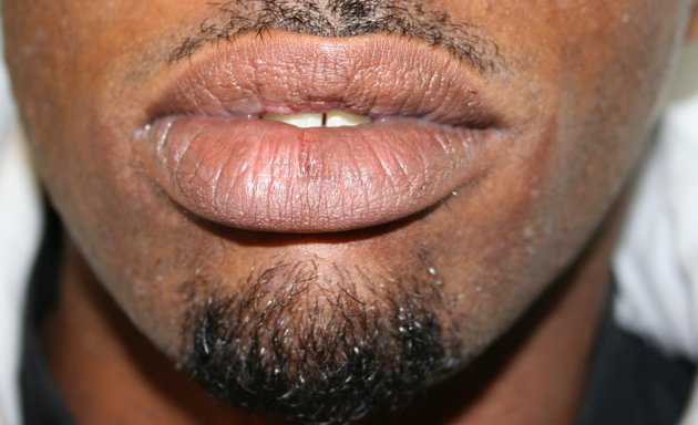 Photo of Appearances | Skin Lesion Removals