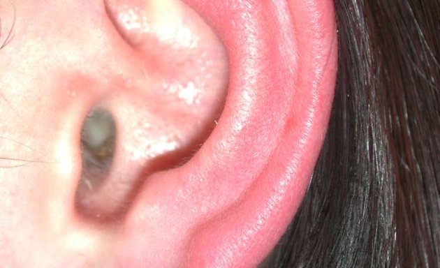 Photo of ear Aesthetics and Reconstruction