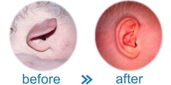 Photo of ear Aesthetics and Reconstruction