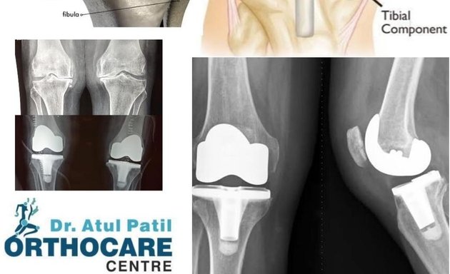 Photo of Dr. Atul Patil's Orthocare Center : Orthopaedic Surgeon | Bone Doctor | Slip Disc , Sciatica , Knee , Joints , Back , Neck , Ankle Specialist & Replacement| Fracture Specialist | Arthritis , Osteoporosis , Sport Injuries Treatment in Mulund