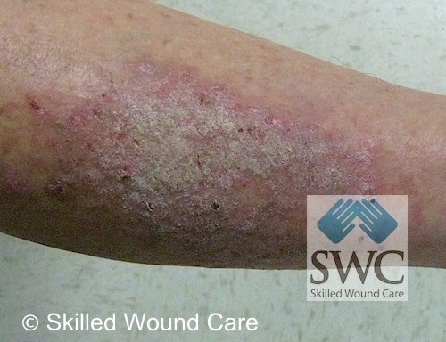 Photo of Skilled Wound Care