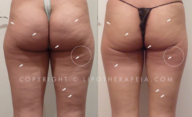 Photo of LipoTherapeia - Advanced skin tightening & cellulite treatments in London