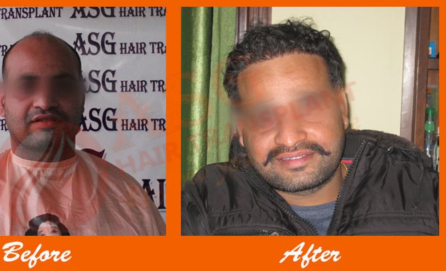 Photo of ASG Hair Transplant Clinic Jalandhar, Punjab, India