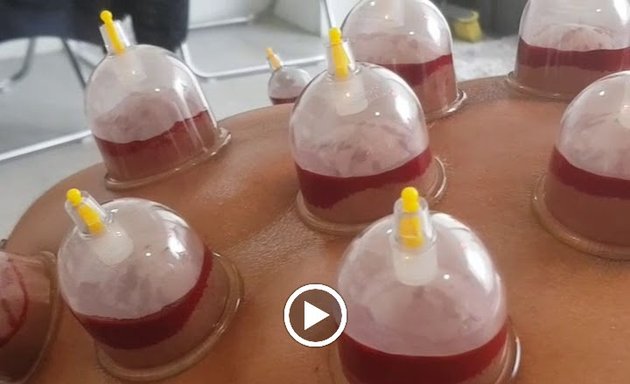 Photo of Cupping Clinic | Hijama | Cupping | Massage