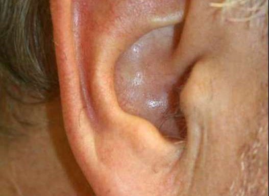 Photo of ear Aesthetics and Reconstruction