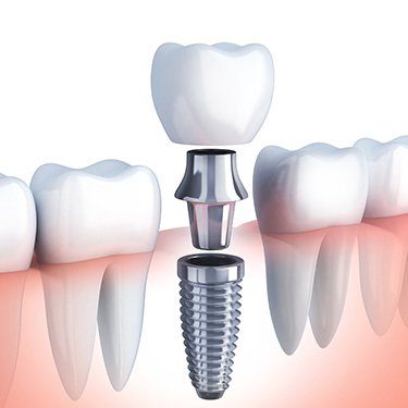 Photo of A+ Dental & Implant Center - San Diego 92126