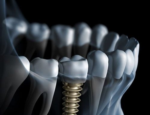 Foto de Implantes Dentales en Cordoba Capital
