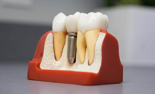 Photo of Tooth Implant Brooklyn