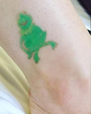 Photo of Removery Tattoo Removal & Fading