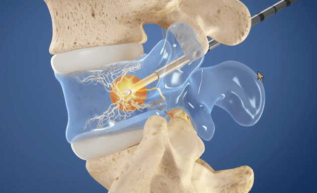 Photo of Spine Pain Be Gone: Guy Fogel, MD, FAAOS
