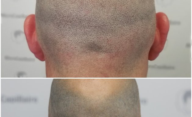Photo of Clinique MicroCapillaire Laval - Scalp Micropigmentation Capillaire
