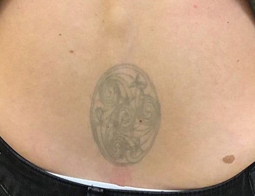Photo of Removery Tattoo Removal & Fading