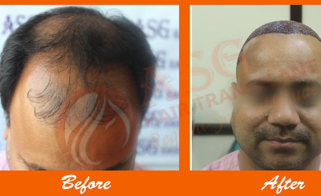 Photo of ASG Hair Transplant Clinic Jalandhar, Punjab, India