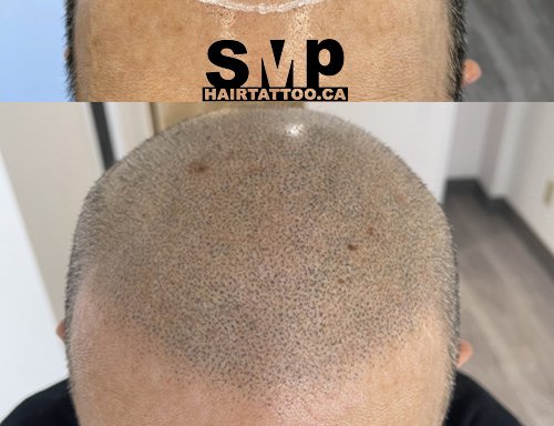 Photo of HAIRTATTOO.CA | SMP® Scalp Micropigmentation Toronto