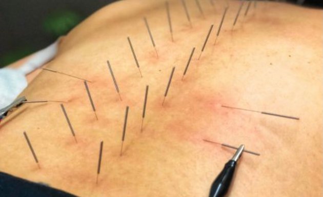 Photo of My Acupuncture Therapy
