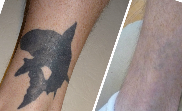 Photo of Fading Fast Laser Tattoo Removal