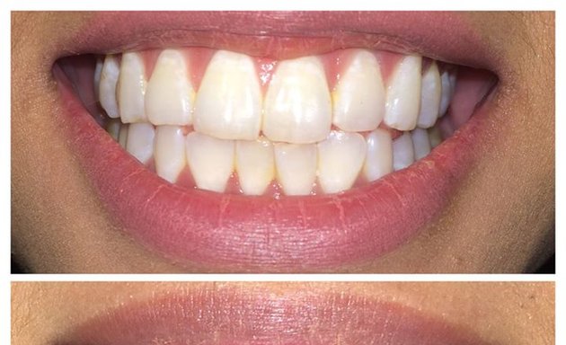 Photo of Glow Teeth Whitening