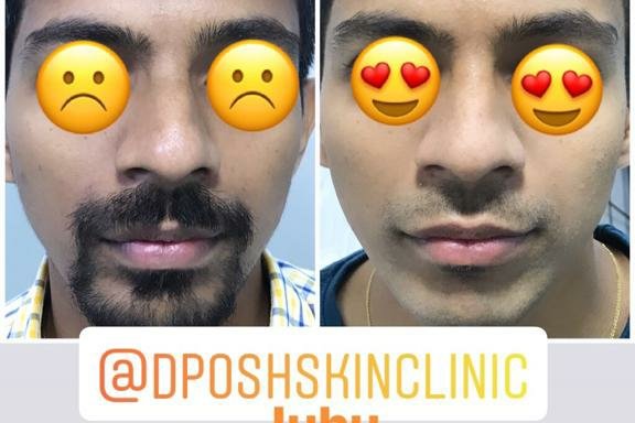 Photo of D-Posh - Skin Hair & Laser Clinic : Tattoo & Scar Removal | PRP | Mole & Wart & Laser Hair Removal | Dermapeel & Dermabrasion & Dermalfillers | Botox | Phototherapy | Pigmentation Treatment in JUHU