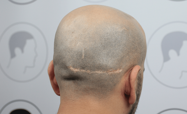 Foto von Haarpigmentierung | Modern Hair Loss Solution