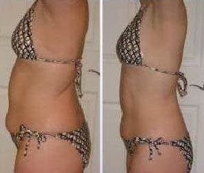 Photo of LoveLipo (Non-Surgical Inch Loss) - Sheffield (Middlewood Rd)