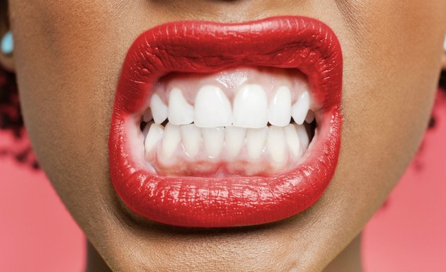 Photo of Hollywood Smiles Teeth Whitening