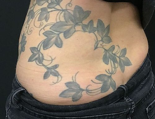 Photo of Removery Tattoo Removal & Fading