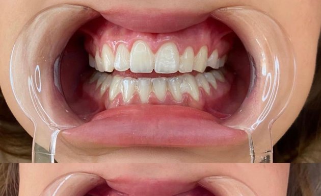 Photo of Lux Natural Teeth Whitening