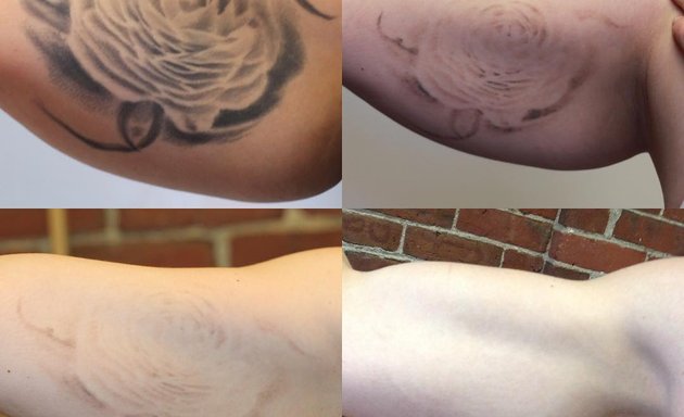 Photo of Removery Tattoo Removal & Fading