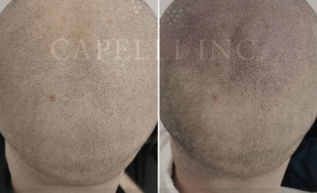 Photo of Capelli Inc Scalp Micropigmentation Liverpool