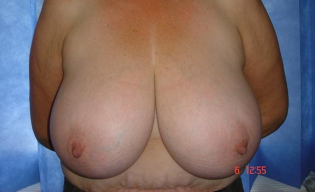 Photo of Cosmetic Breast Surgeon