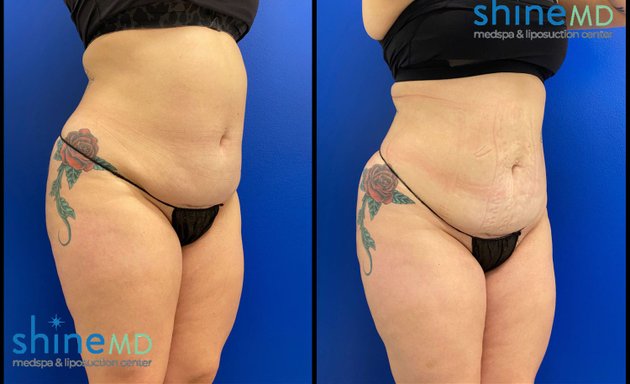 Photo of ShineMD Medspa & Liposuction Center in Houston, TX