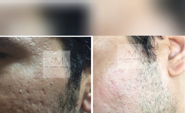 Photo of SkinGenious Colaba | HIFU treatment, Lip fillers, Hair, skin specialist clinic