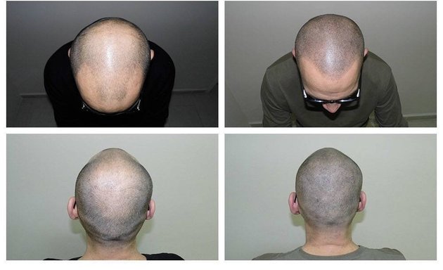 Photo of The Bald Cure Vancouver Scalp Micropigmentation Kevin Harper