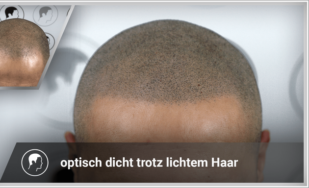 Foto von Haarpigmentierung | Modern Hair Loss Solution