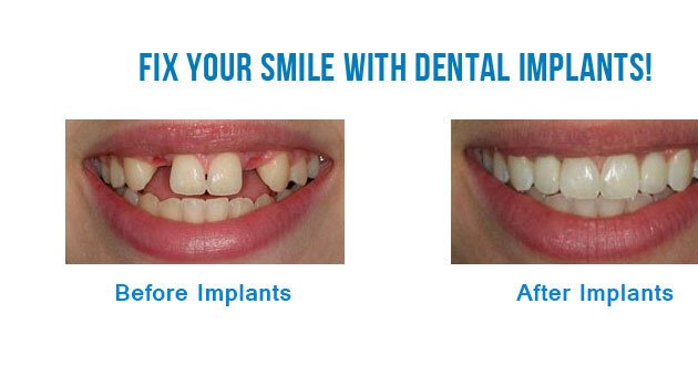 Photo of Tooth implant dentist