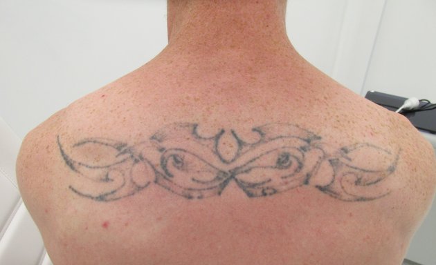 Photo of Ink Undone Tattoo Removal Clinic