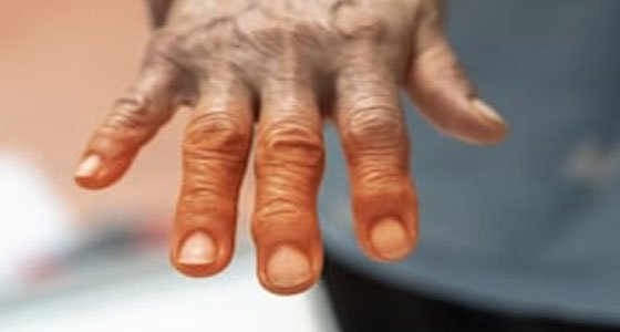 Photo of arthritisCARE - Rheumatologist Brisbane