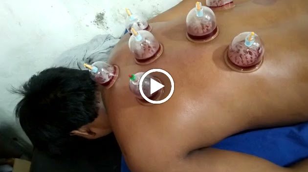 Photo of cure hijama, cupping therapy,accupunture holistic healing centre.