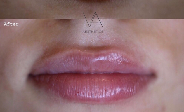 Photo of V&A Aesthetics - London Lip Fillers, Chin, Nose, Cheek & Jaw Filler Clinic