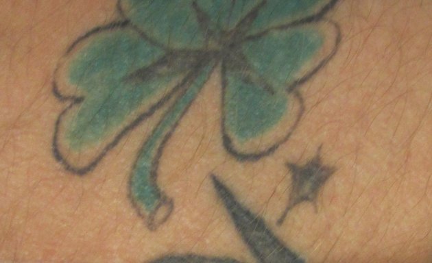 Photo of Ink Undone Tattoo Removal Clinic