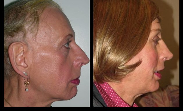 Photo of Facial Feminization Surgery