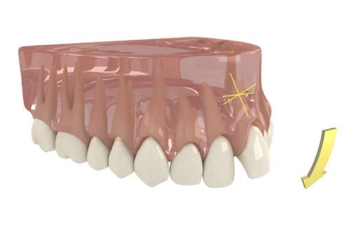 Photo of Inman Aligner