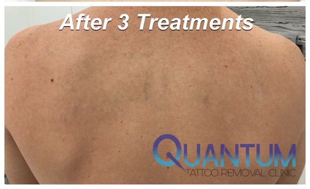 Photo of Quantum Tattoo Removal Clinic