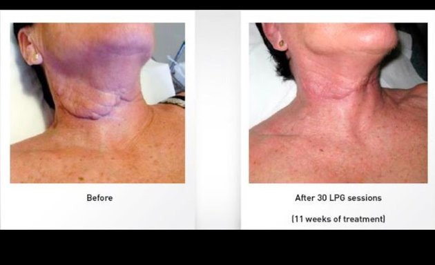 Photo of Lipo Aftercare