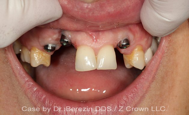 Photo of Z Crown Dental Lab